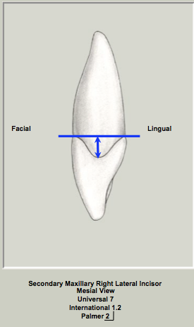 Ext Morph Mx Lateral Mesial 2.png